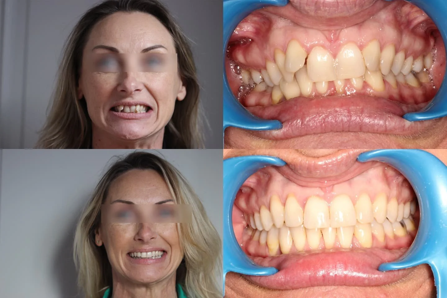 TRAITEMENT RÉALISÉ PAR ALIGNEURS