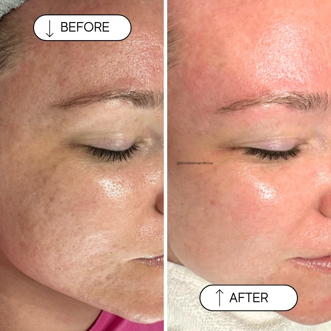 THIS is why we do what we do.⁠
⁠
For results like this. 😍😍😍⁠
⁠
This sweet client had been struggling with her skin for basically her entire adult life! She just wanted to feel more confident.⁠
⁠
We needed to address her specific concerns of: ⁠
⁠
&