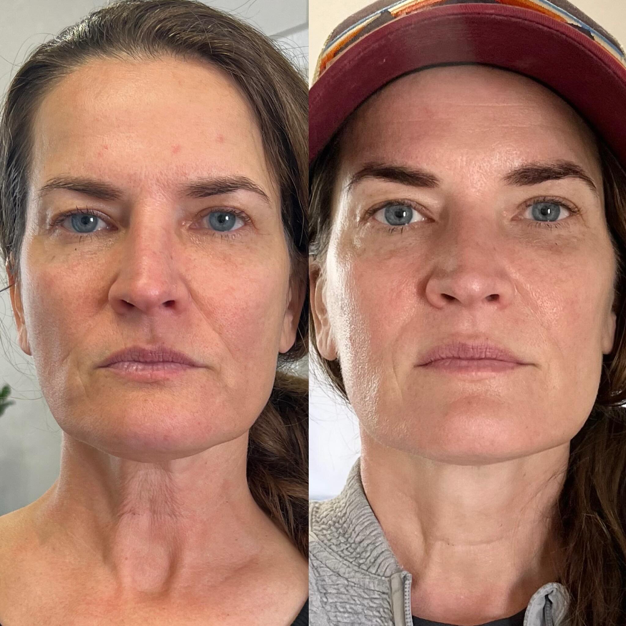 Here is an example of Jet Plasma done with single sessions and not within the time frame suggested which is 48-72 hours a part. My beautiful friend had her first session done about two months ago in December and the second session was done today. Sin