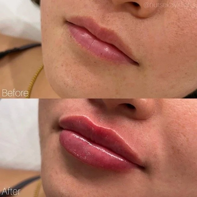 Kanvasd_Cosmetic_Clinic_Brisbane_Dermal_Filler_2.jpeg