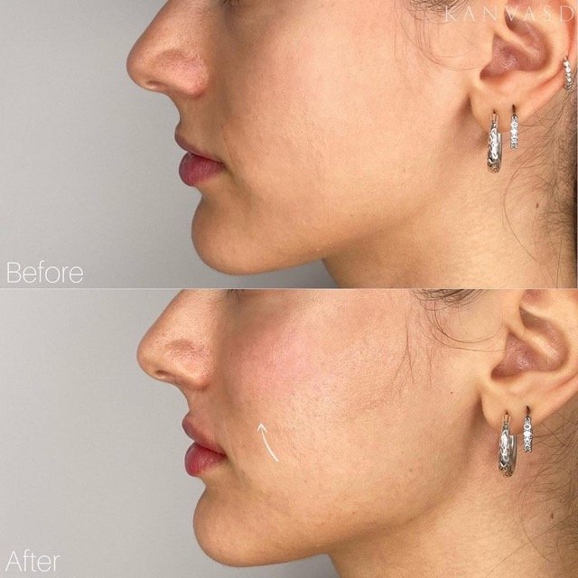 Kanvasd_Cosmetic_Clinic_Brisbane_Dermal_Filler_3.jpeg