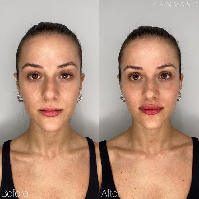 Kanvasd_Cosmetic_Clinic_Brisbane_Dermal_Filler_4.jpeg