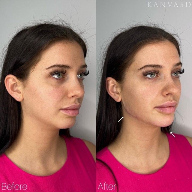 Kanvasd_Cosmetic_Clinic_Brisbane_Dermal_Filler_6.jpeg