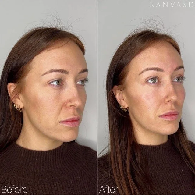 Kanvasd_Cosmetic_Clinic_Brisbane_Dermal_Filler_8.jpeg