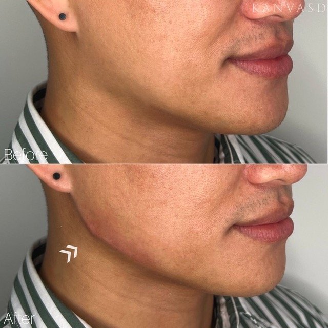 Kanvasd_Cosmetic_Clinic_Brisbane_Dermal_Filler_10.jpeg