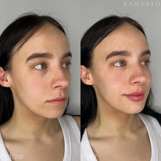Kanvasd_Cosmetic_Clinic_Brisbane_Dermal_Filler_13.jpeg