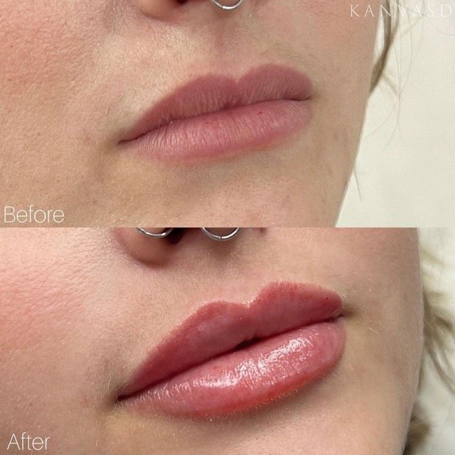 Kanvasd_Cosmetic_Clinic_Brisbane_Dermal_Filler_15.jpeg