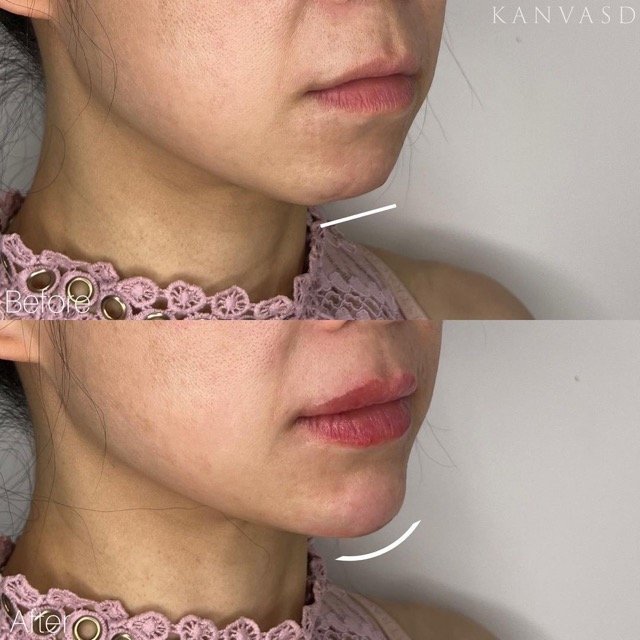 Kanvasd_Cosmetic_Clinic_Brisbane_Dermal_Filler_16.jpeg