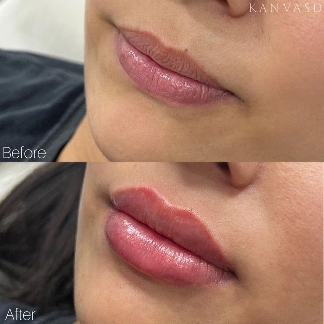 Kanvasd_Cosmetic_Clinic_Brisbane_Dermal_Filler_17.jpeg