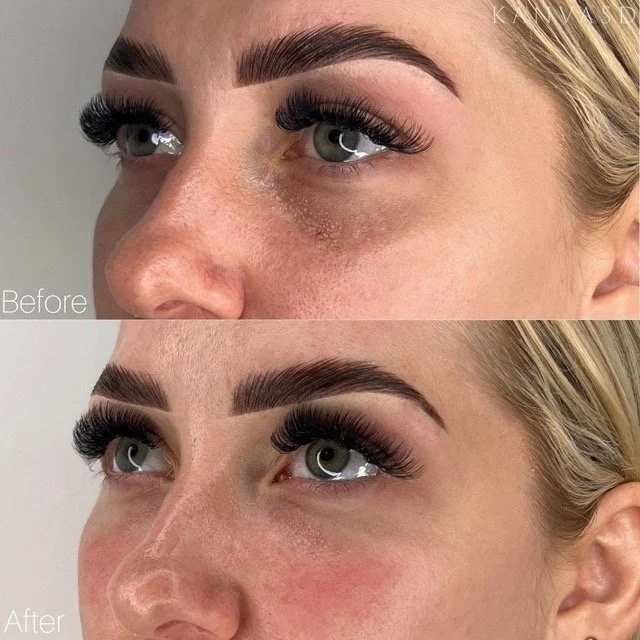 Kanvasd_Cosmetic_Clinic_Brisbane_Dermal_Filler_18.jpeg