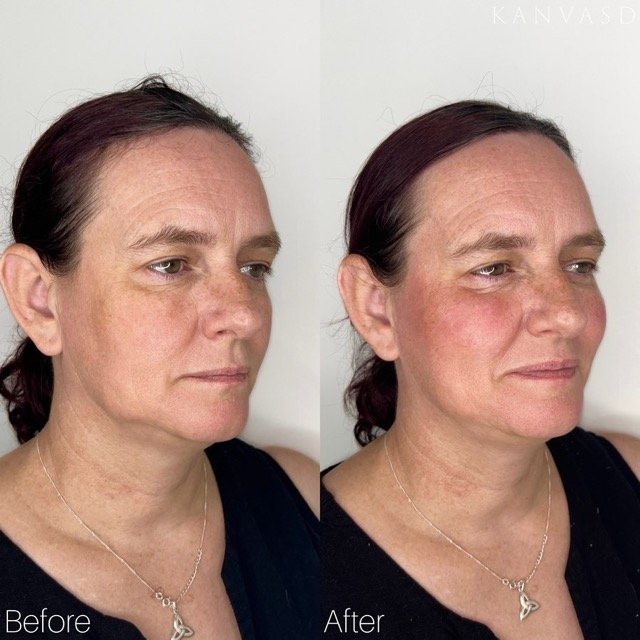 Kanvasd_Cosmetic_Clinic_Brisbane_Dermal_Filler_20.jpeg