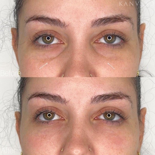 Kanvasd_Cosmetic_Clinic_Brisbane_Dermal_Filler_21.jpeg