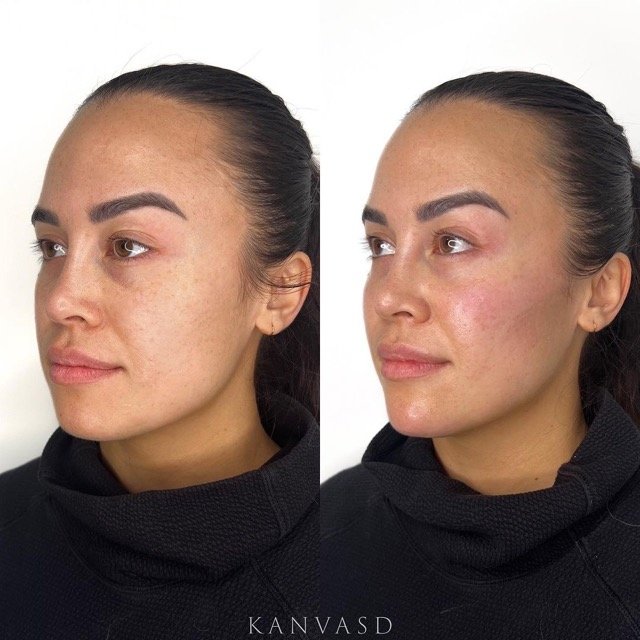 Kanvasd_Cosmetic_Clinic_Brisbane_Dermal_Filler_22.jpeg