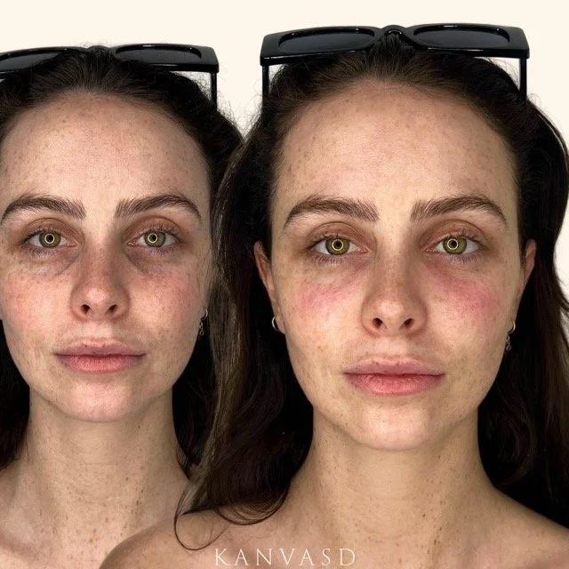 Kanvasd_Cosmetic_Clinic_Brisbane_Dermal_Filler_24.jpeg