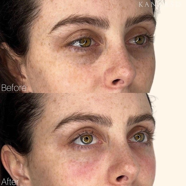 Kanvasd_Cosmetic_Clinic_Brisbane_Dermal_Filler_25.jpeg