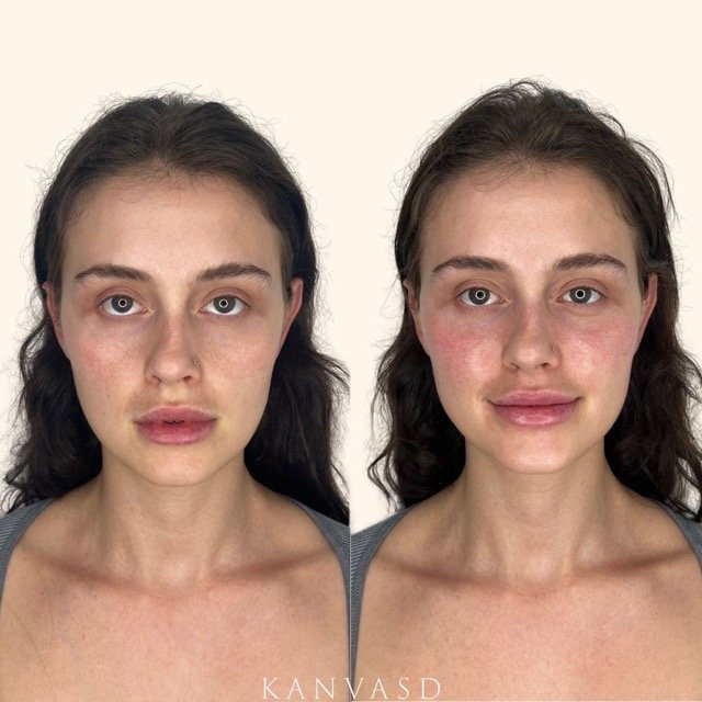 Kanvasd_Cosmetic_Clinic_Brisbane_Dermal_Filler_26.jpeg