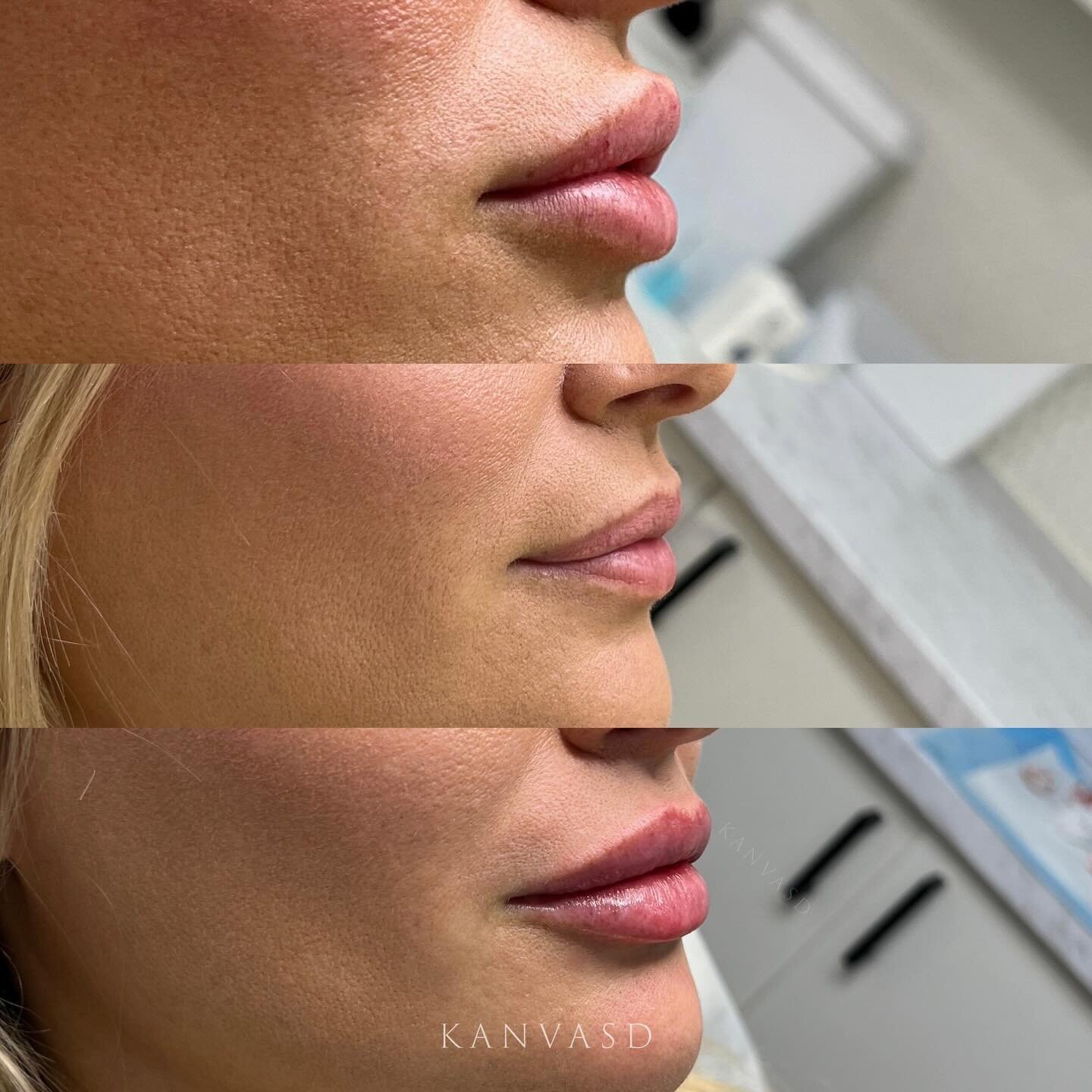 At Kanvasd, we provide a tailored and unique treatment plan for each individual. Our nurses specialise in assessing facial anatomy and can provide personalised consultations regarding facial rejuvenation.

Practitioner: Registered Nurse Kayleigh

For