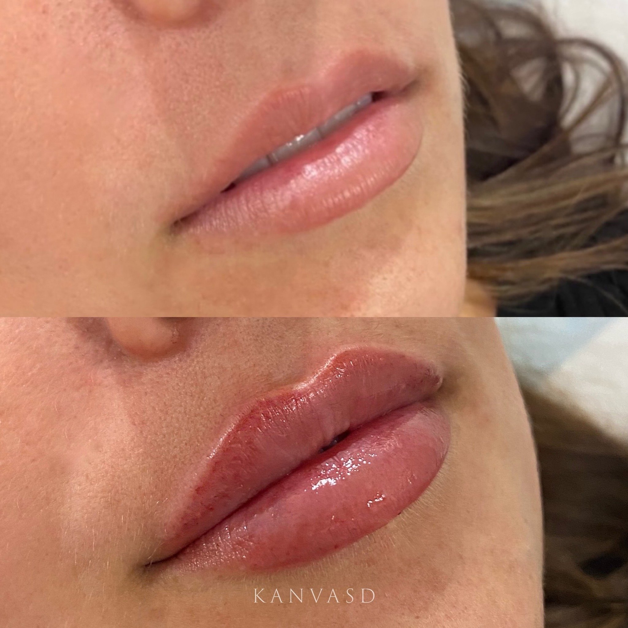 At Kanvasd, we provide a tailored and unique treatment plan for each individual. Our nurses specialise in assessing facial anatomy and can provide personalised consultations regarding cosmetic injectables and skin treatments.

Practitioner: Registere