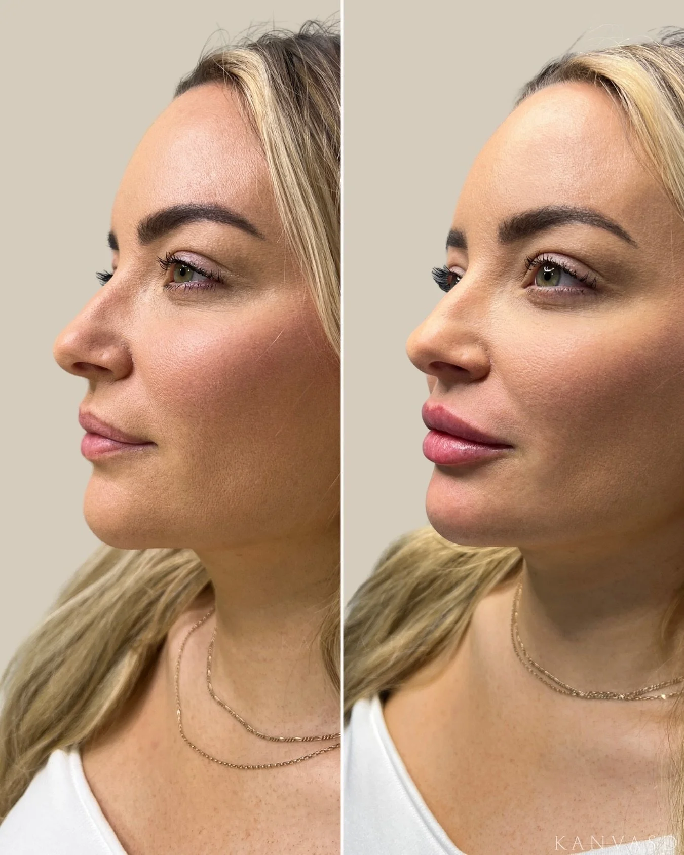 True facial balance starts with understanding your facial proportions as a whole. During your consultation, we assess structure, movement, and harmony to create a tailored treatment plan aligned with your goals and natural anatomy.

Instagram: @kanva