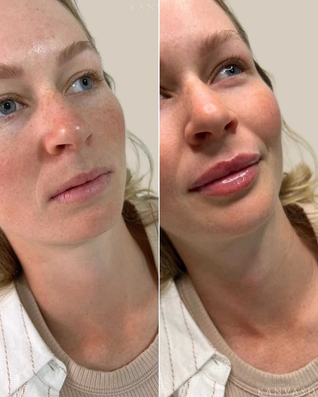 At Kanvasd Clinic, every treatment is carefully mapped to your anatomy, your expressions, and your goals. 

We support what&rsquo;s already yours, never altering who you are 🤍

Instagram: @kanvasdclinic 
Email: info@kanvasd.com.au
Location: 172 Gymp