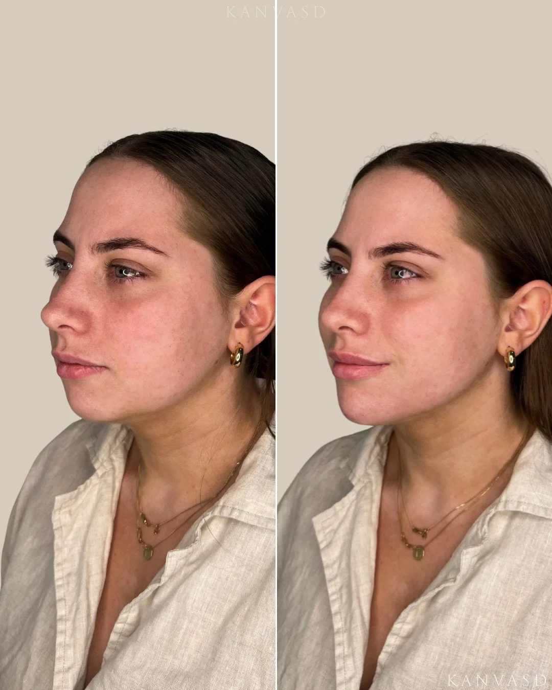 Concerned about your lower face or asymmetric volume loss? Schedule a consultation today. 

At Kanvasd Clinic, our nurses provide consultations on concerns of volume loss, skin laxity, facial harmony, hydration and more! 

Practitioner: Registered Nu