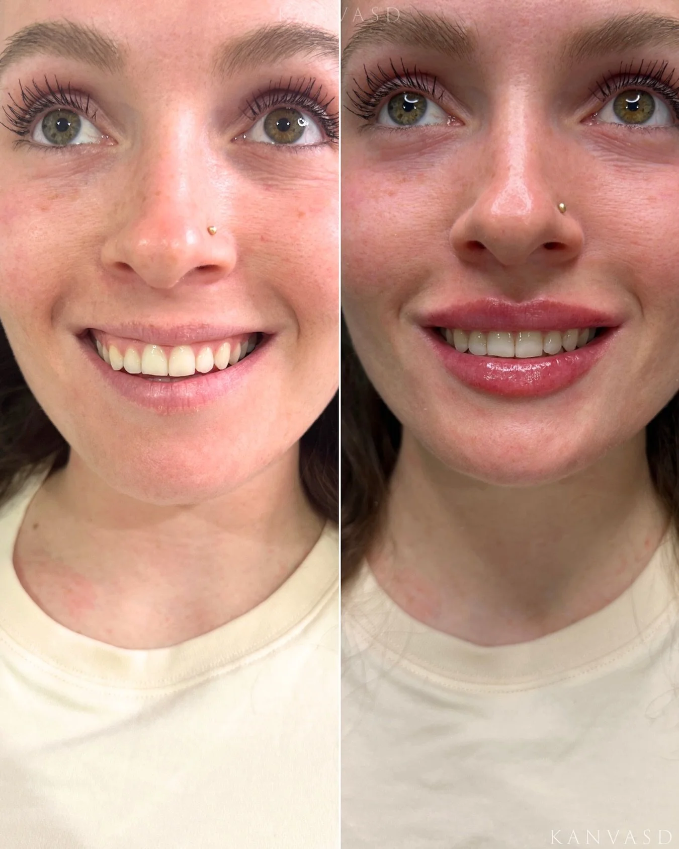 At Kanvasd Clinic, we offer personalised consultations to explore your aesthetic concerns and discuss treatment options tailored to you. 

RN: Nurse Kayleigh NMW0002067810

Instagram: @kanvasdclinic 
Email: info@kanvasd.com.au
Location: 172 Gympie Ro