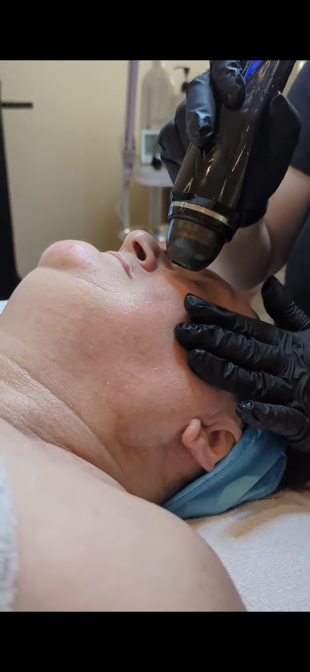 Hydrodermabrasion handpiece used for fluid exfoliation and serum infusion