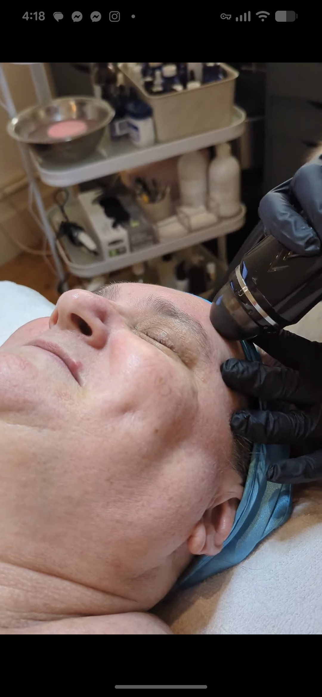 Hydrodermabrasion treatment performed at Open House Skin in Richmond