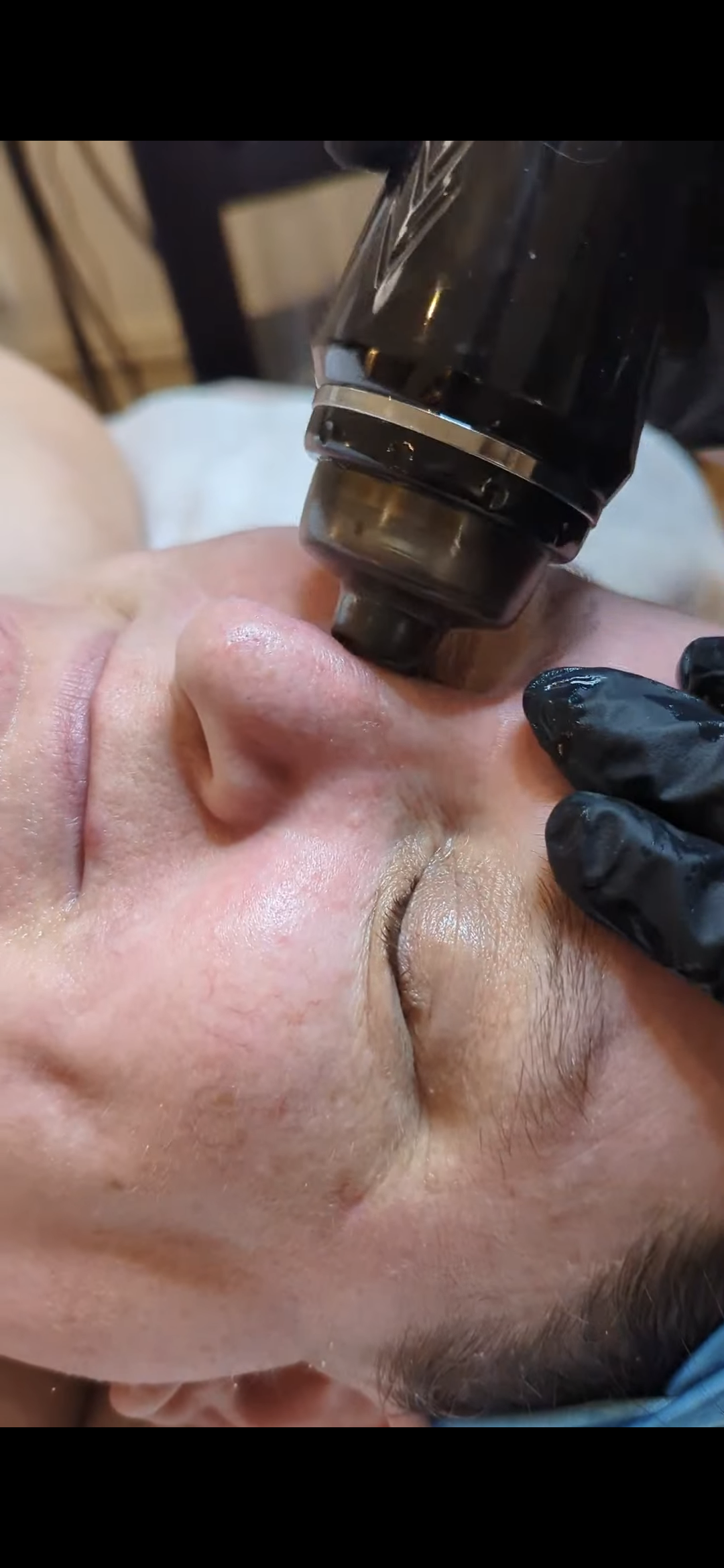 Hydrodermabrasion treatment performed at Open House Skin in Richmond