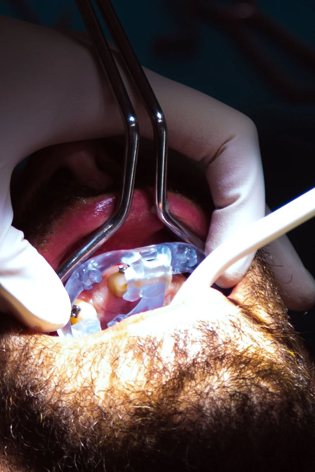 Minore ingombro verticale