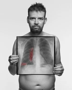 Cameron, 52 / Never-smoker / Symptoms: Fatigue, Persistent cough