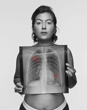 Razia, 37 / Never-smoker / Symptoms: Persistent chest & rib pain