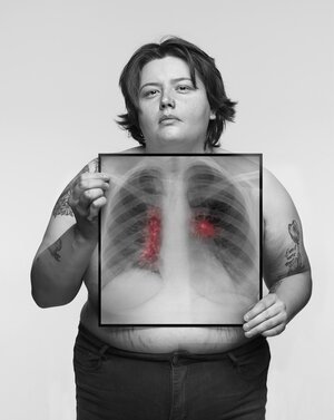 Amelia, 26 / Non-smoker / Symptoms: Back pain, Persistent cough