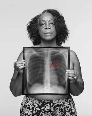 Brenda, 64 / Never-smoker / Symptom: Persistent cough