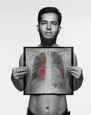 Jaber, 37 / Never-smoker / Symptoms: Persistent cough, Breathlessness