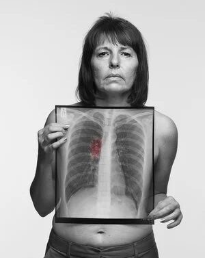 Debbie, 46 / Never-smoker / Symptom: Swelling in neck