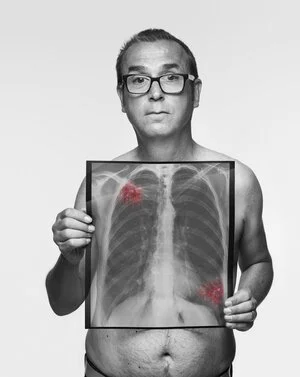 Pete, 50 / Never-smoker / Symptom: Recurrent chest infection