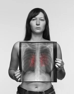 Faye, 28 / Never-smoker / Symptoms: Back pain, Persistent cough