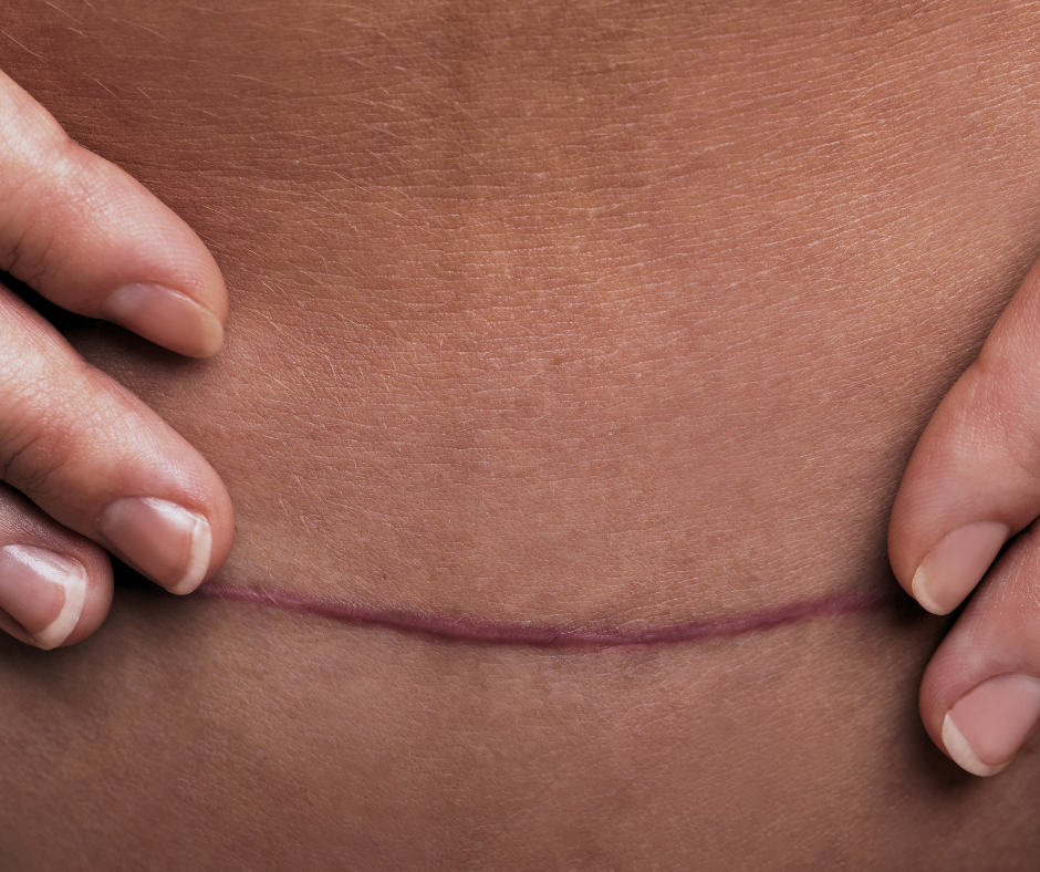Close-up of a person's abdomen with a surgical scar.