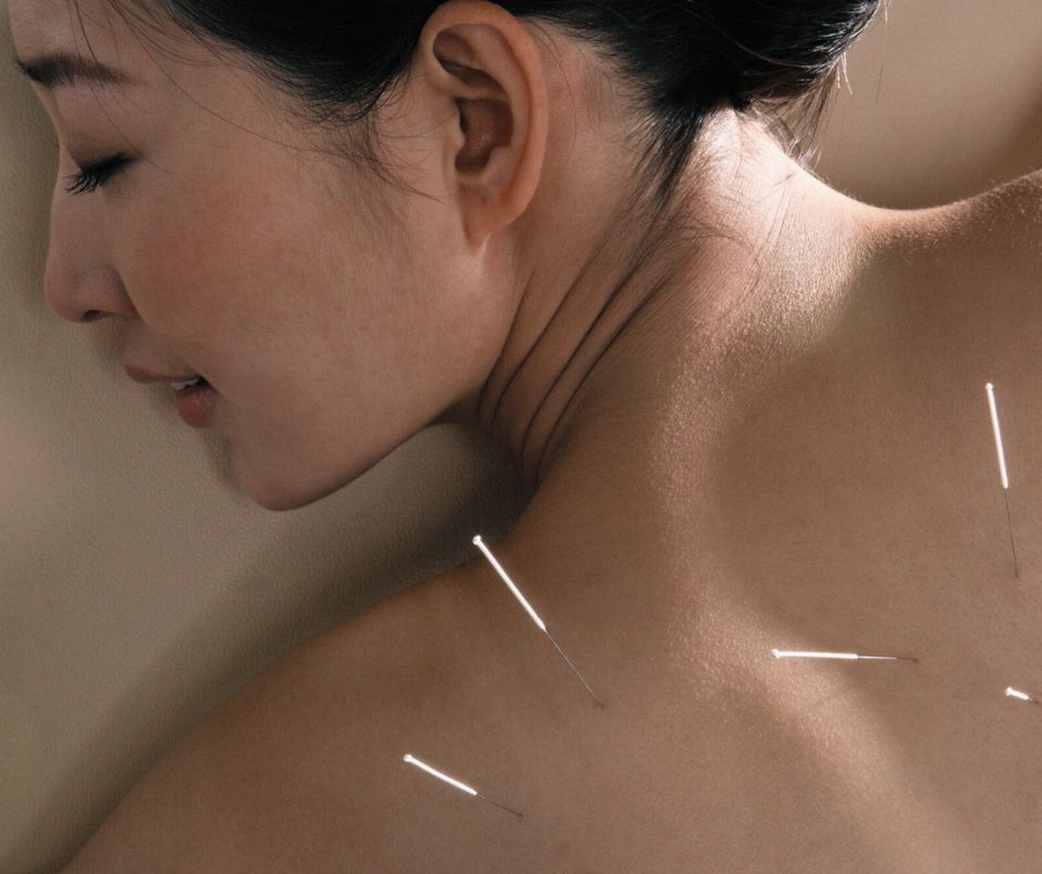 Acupuncture treatment with chiropractic
