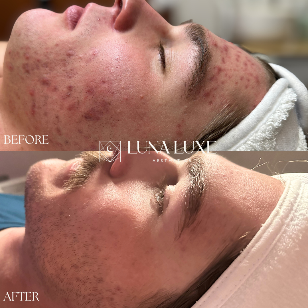 Acne Before & After