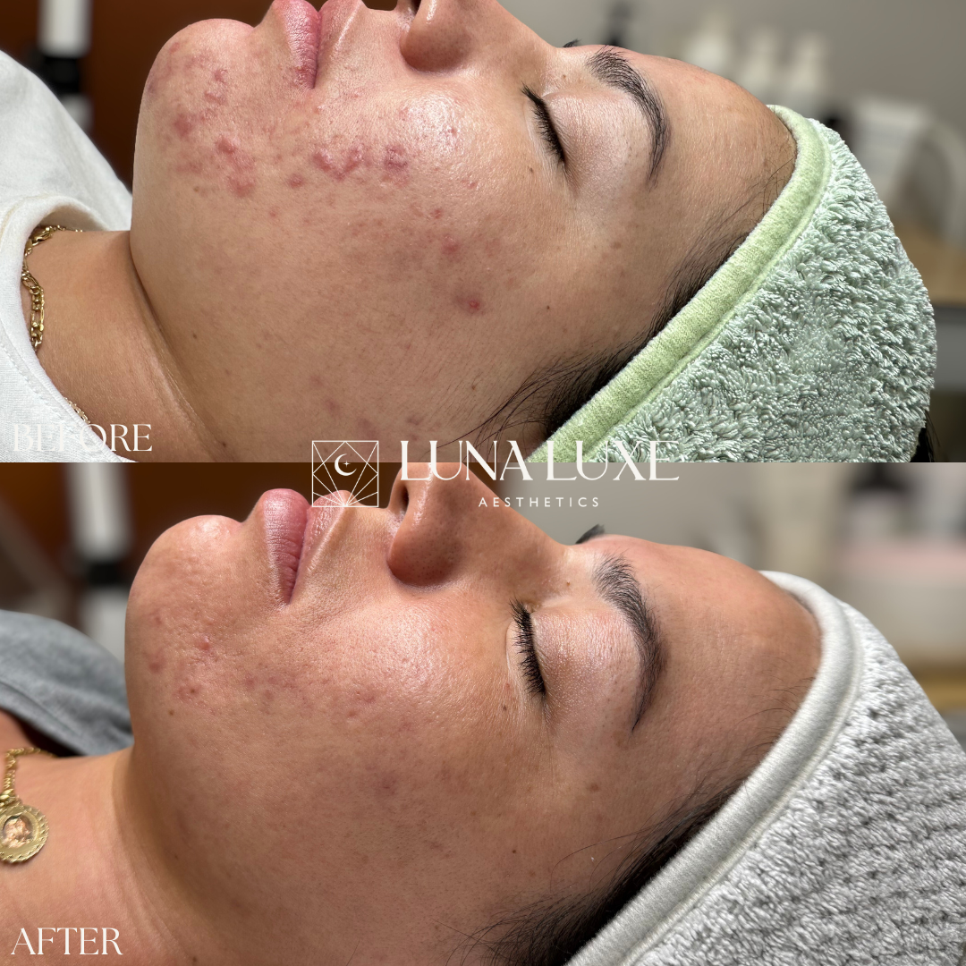 Acne Before & After