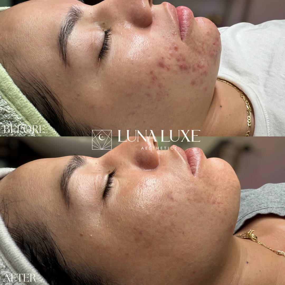 Acne Before & After