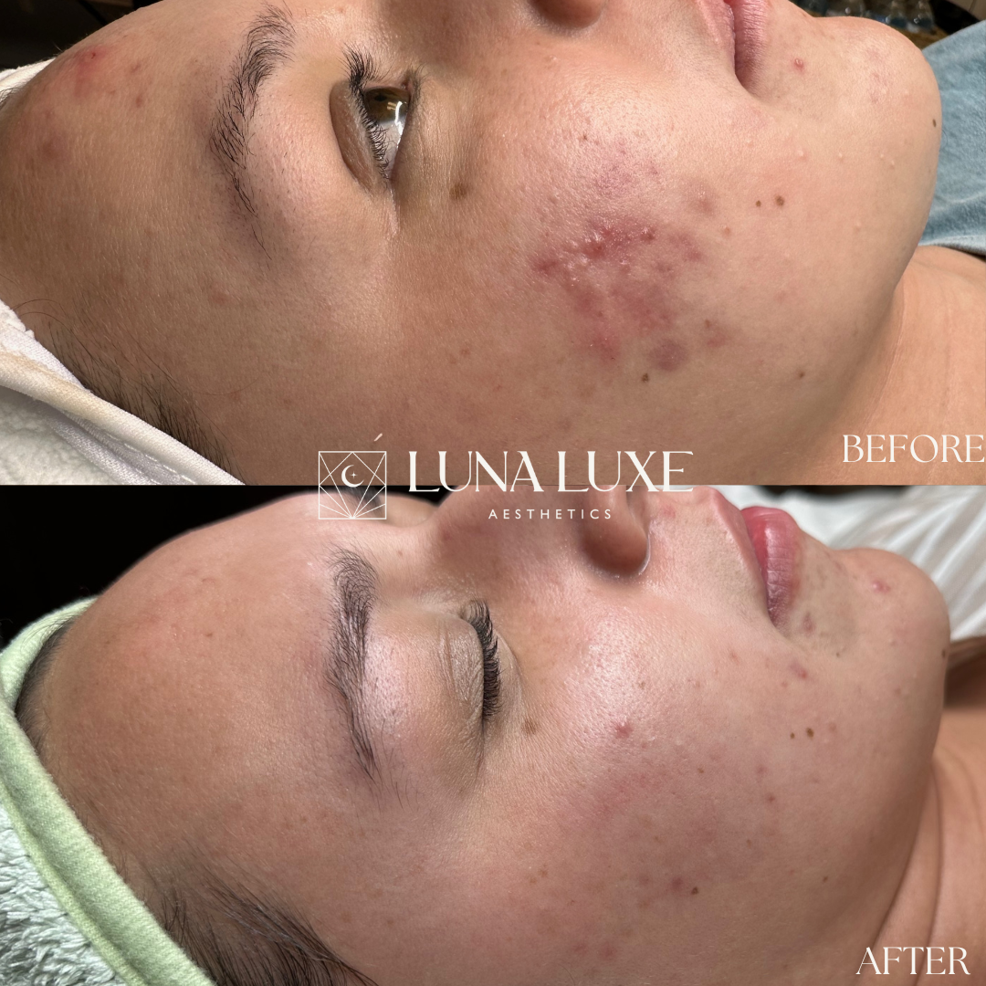acne before and afters (4).png