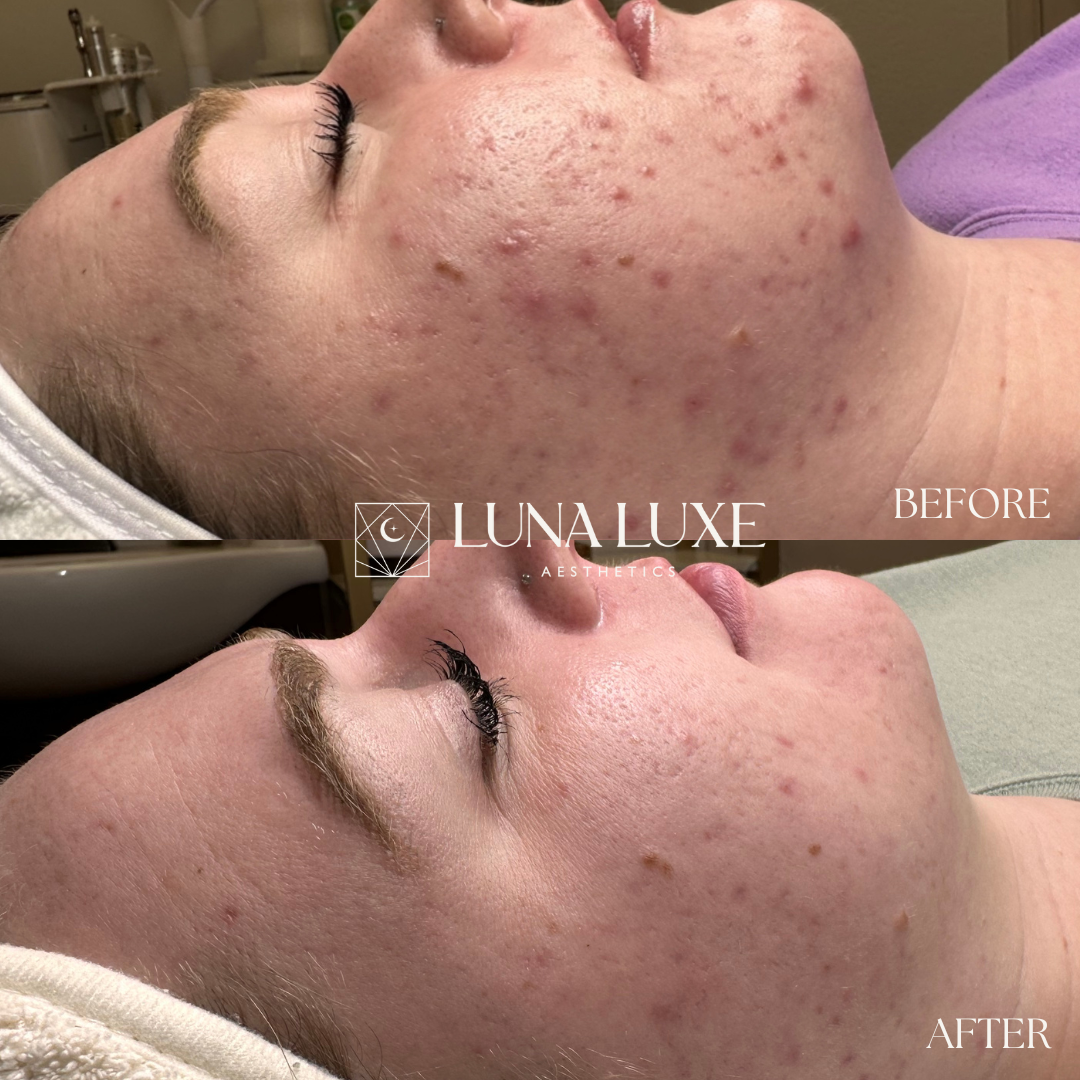 Acne Before & After