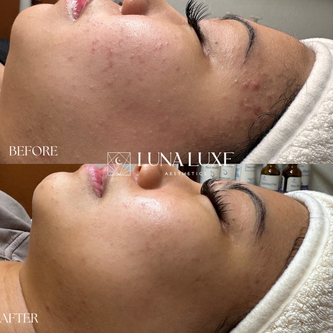 acne before and afters (3).png