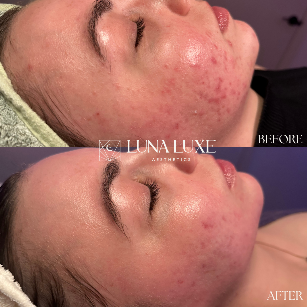 Acne Before & After