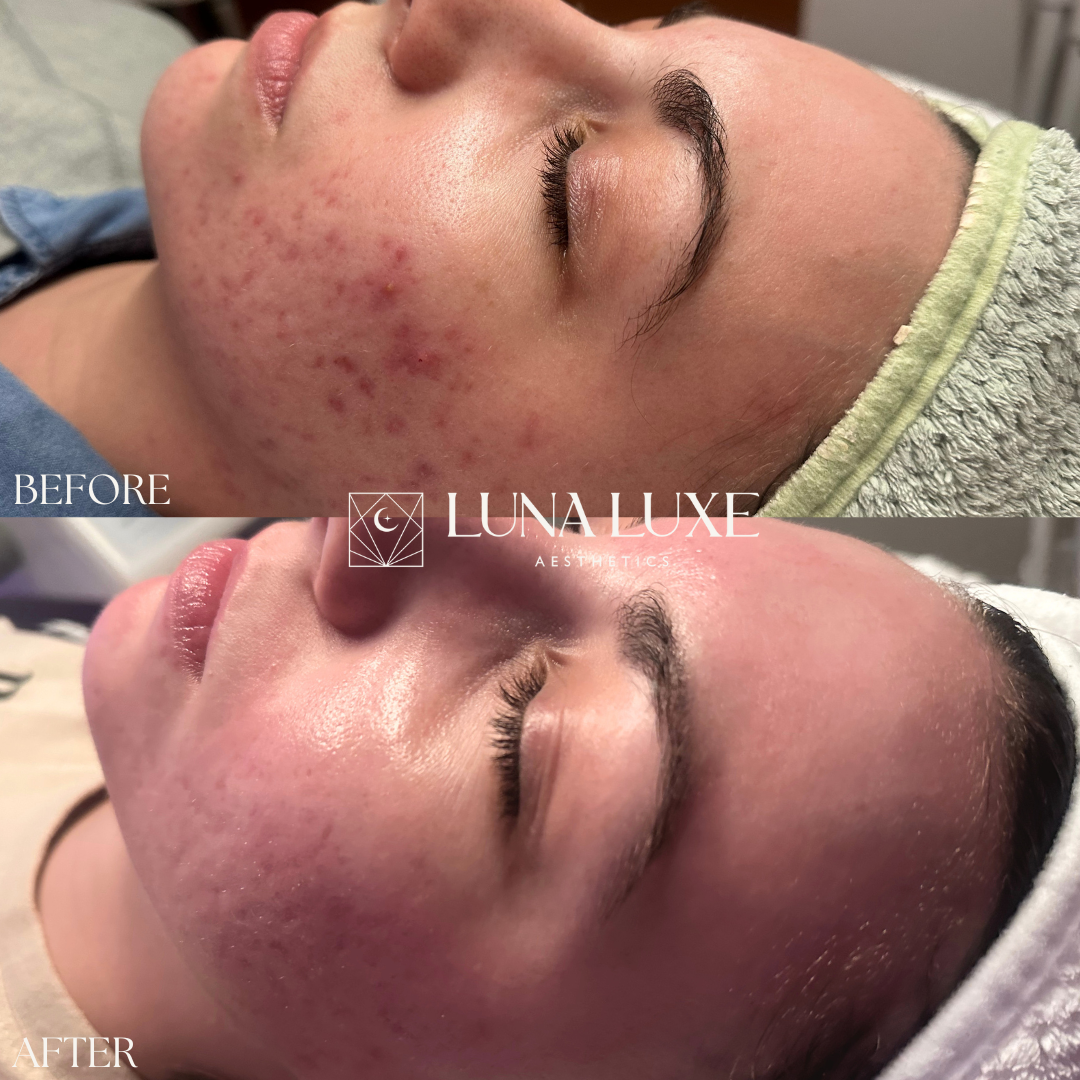 Acne Before & After