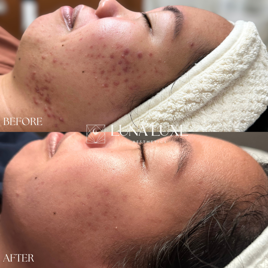 Acne Before & After