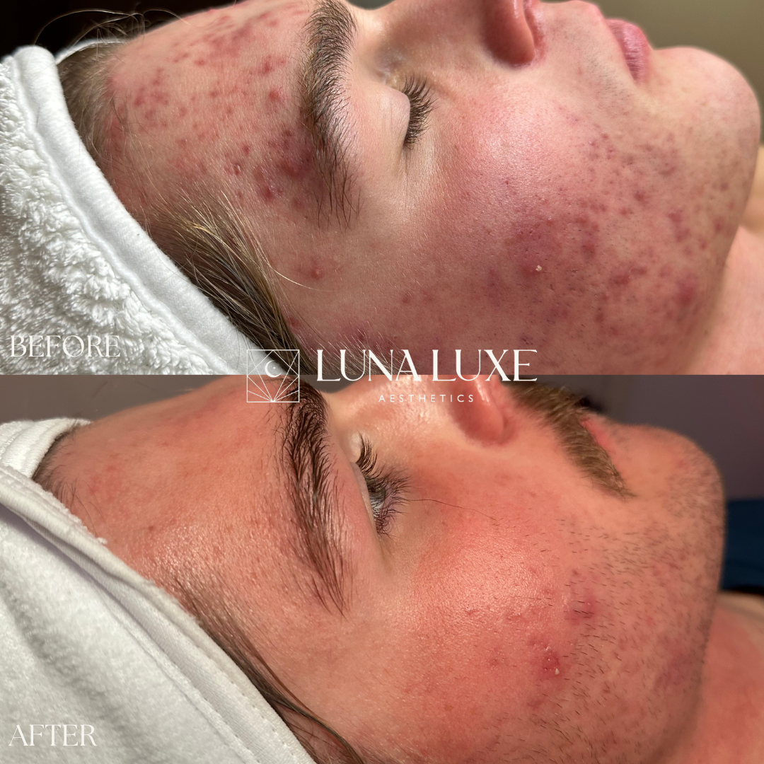 Acne Before & After